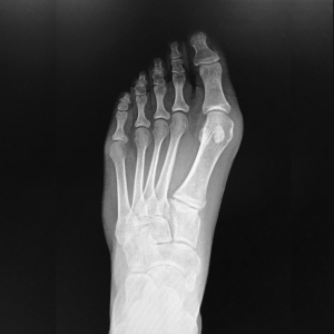 joanete em crianças e adolescentes